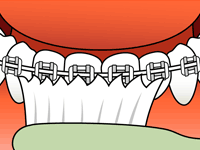 brushing diagram