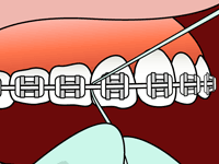 flossing diagram